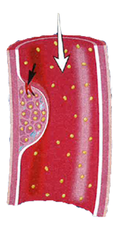 Abrupt plaque rupture