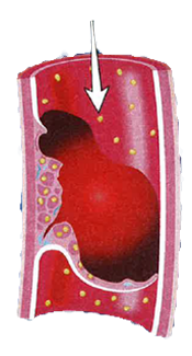 blockage of blood flow that causes a heart attack